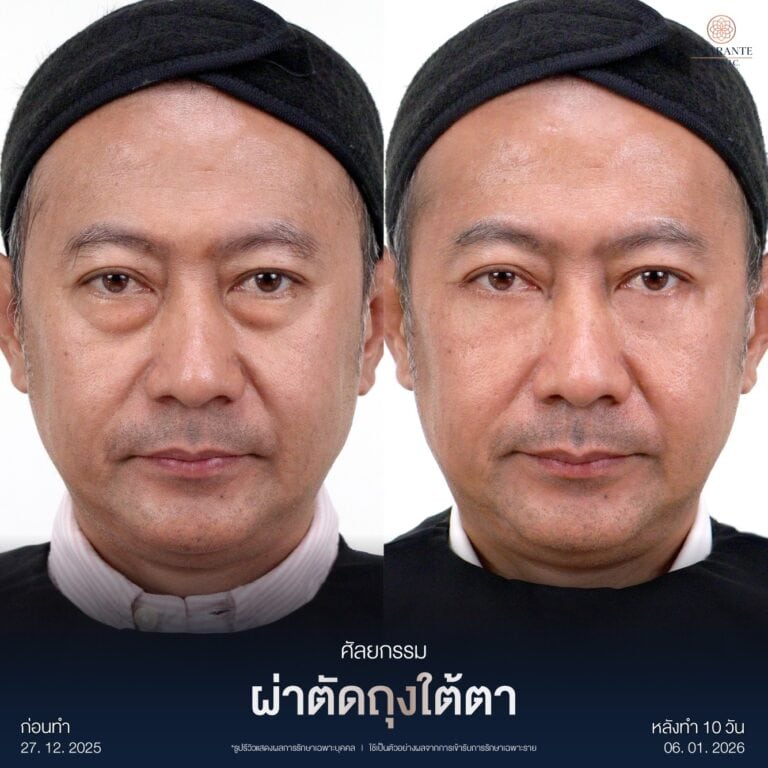 รีวิวผ่าตัดถุงใต้ตา
