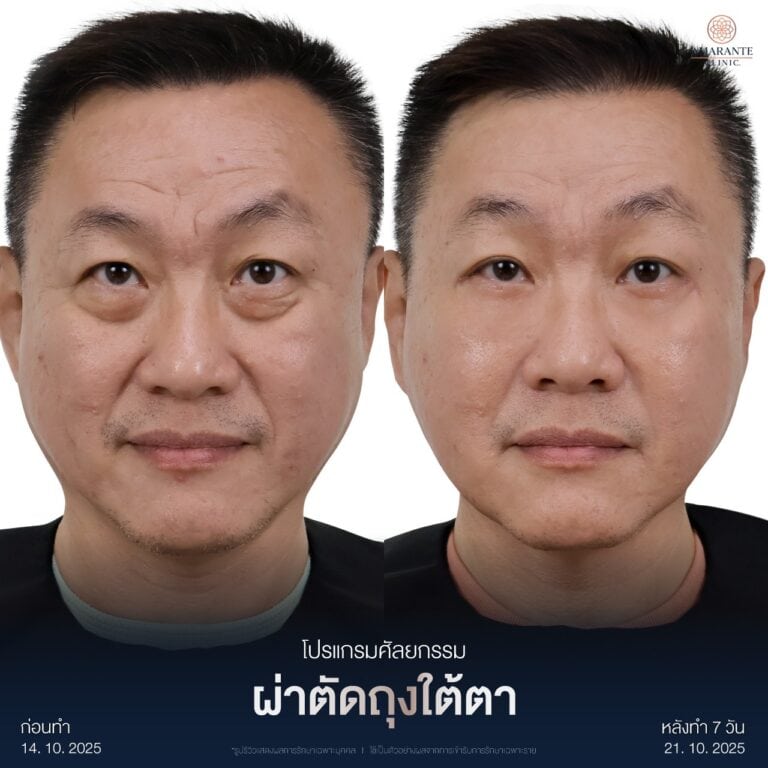 รีวิวผ่าตัดถุงใต้ตา