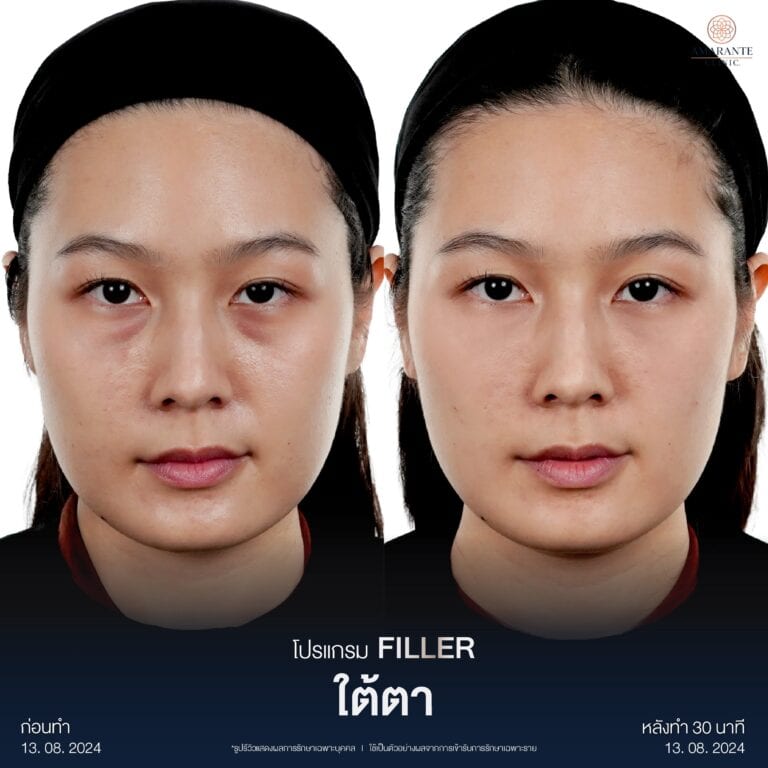 รีวิวฉีดฟิลเลอร์ใต้ตา