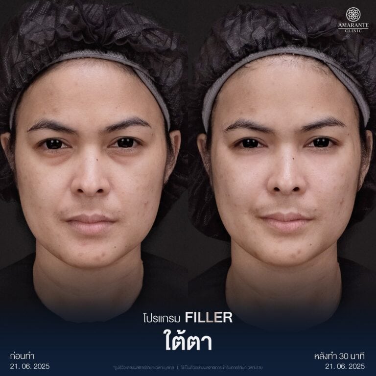 รีวิวฉีดฟิลเลอร์ใต้ตา
