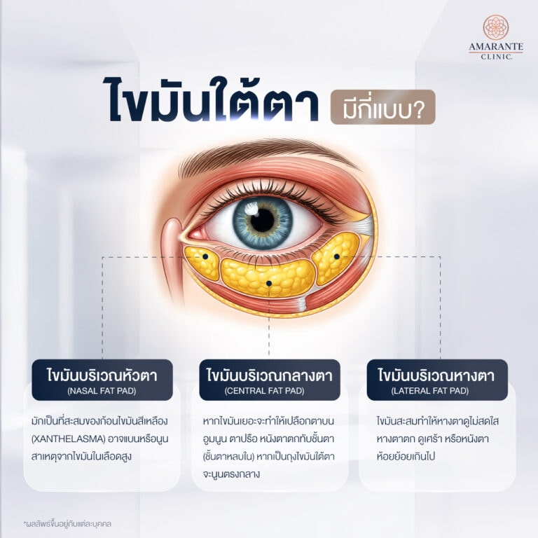 ไขมันใต้ตาคืออะไร และมีลักษณะอย่างไร