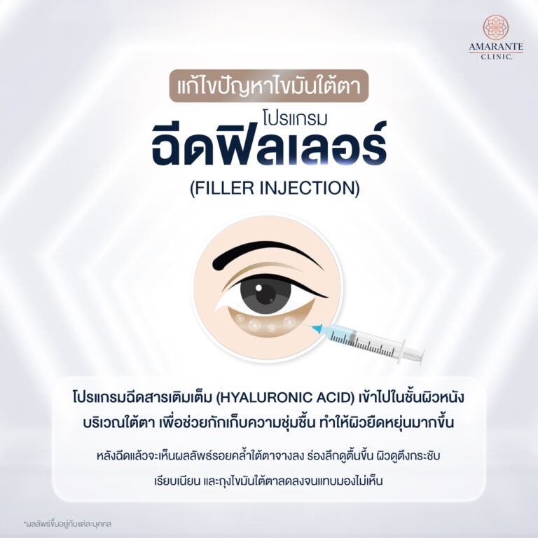 ฉีดฟิลเลอร์แก้ปัญหาใต้ตา