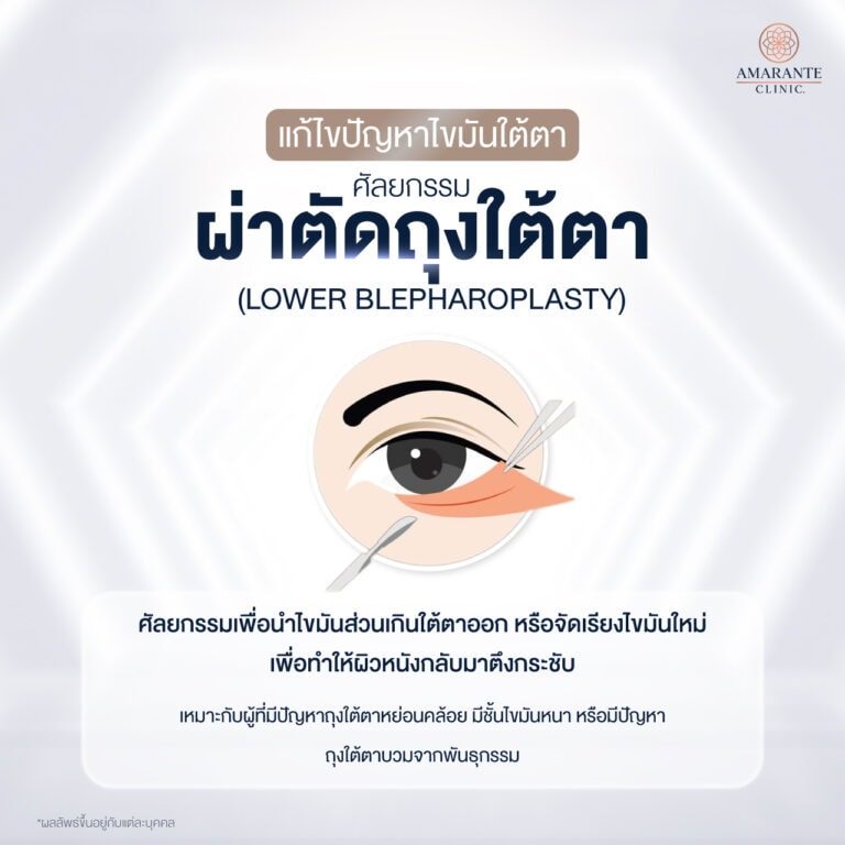 ผ่าตัดถุงใต้ตา