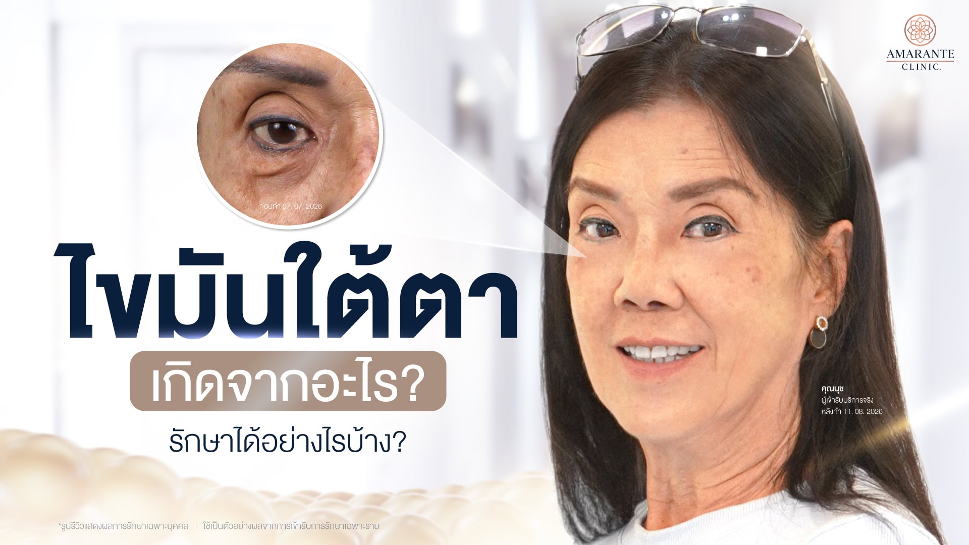 ไขมันใต้ตาเกิดจากอะไร รักษาได้อย่างไร?