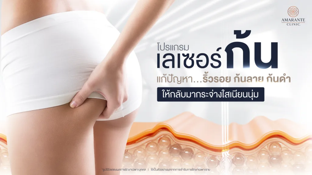เลเซอร์ก้น แก้ปัญหา ริ้วรอย ก้นลาย ก้นดำ