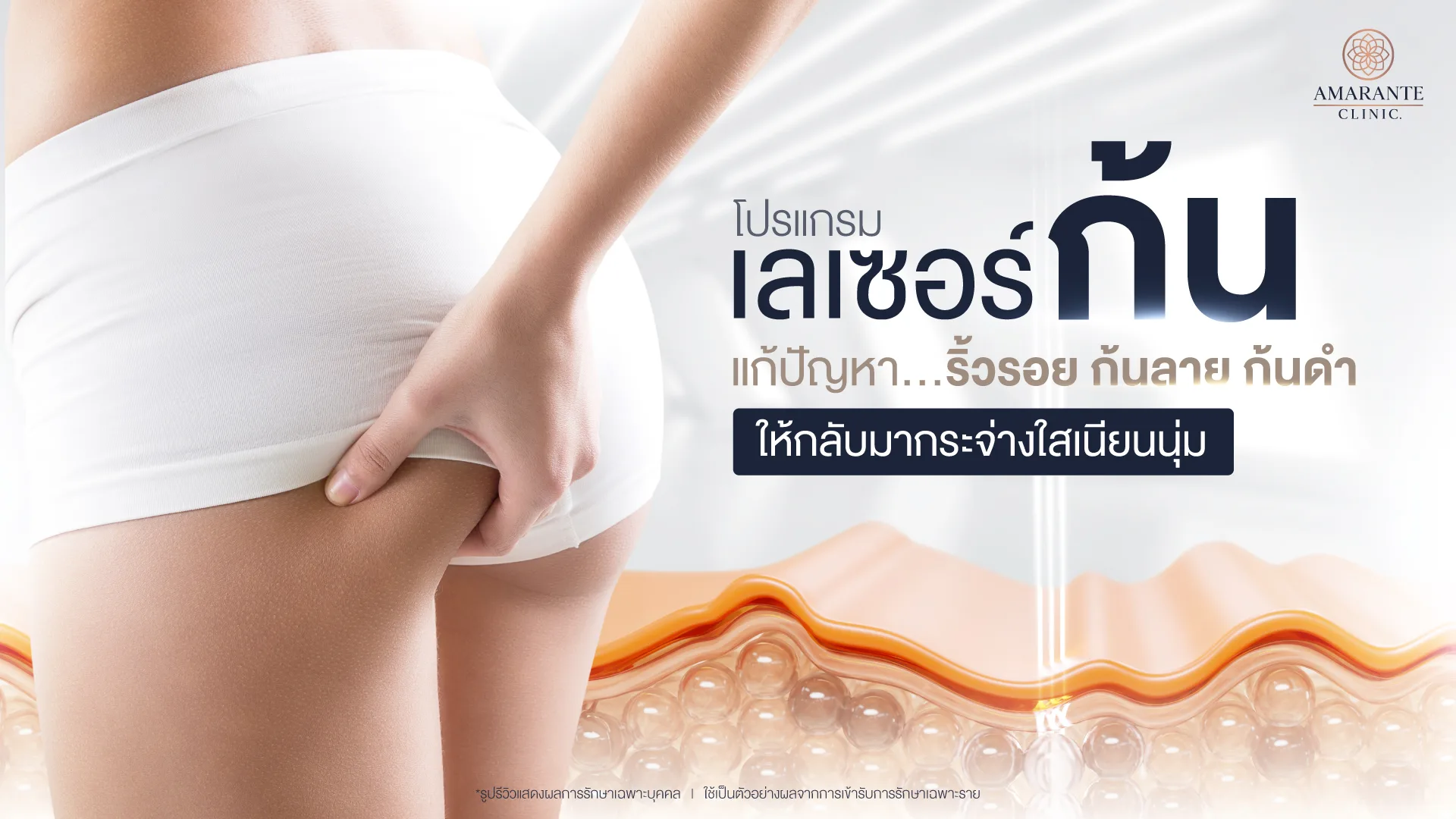 เลเซอร์ก้น แก้ปัญหา ริ้วรอย ก้นลาย ก้นดำ