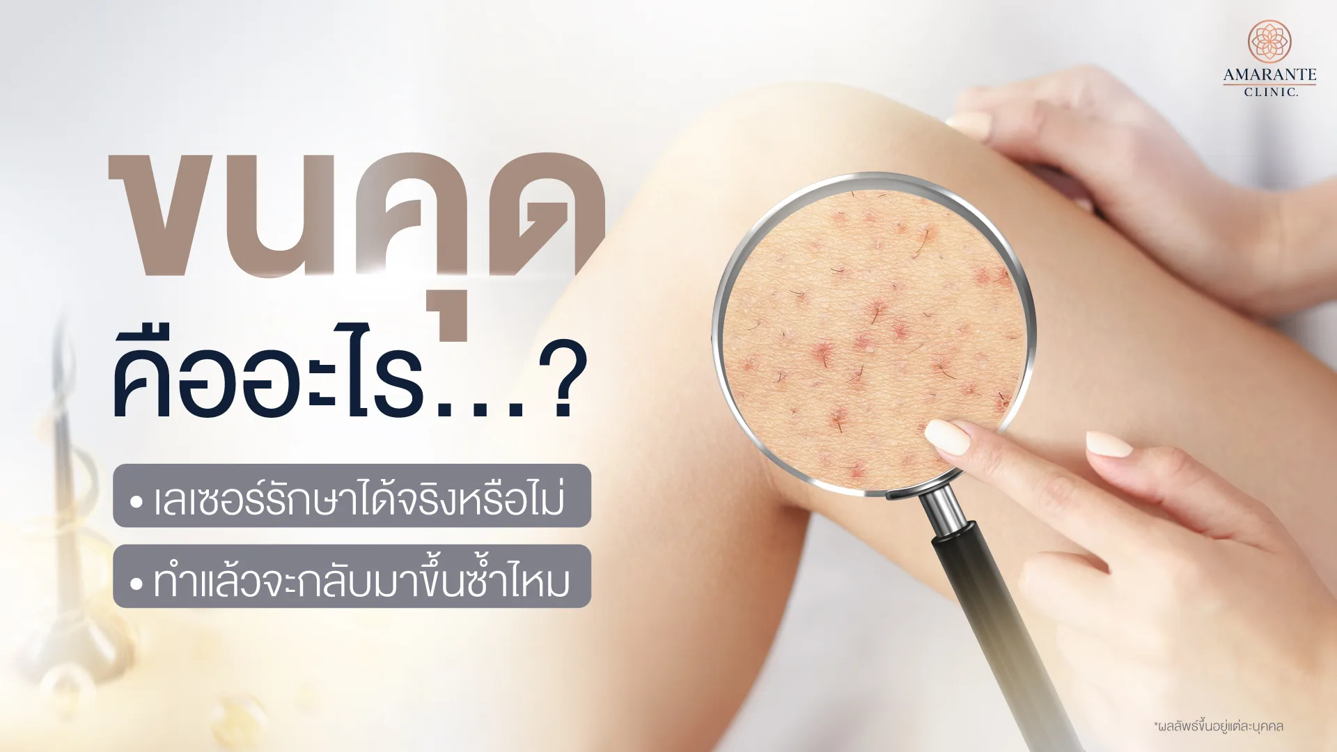 ขนคุดคืออะไร รักษาง่าย ๆ ด้วยการเลเซอร์