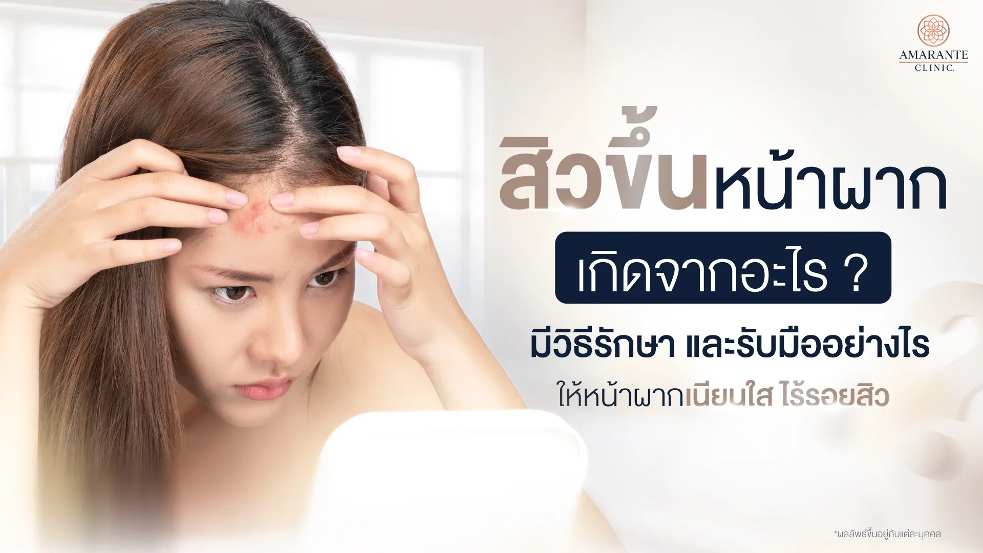 เรื่องควรรู้ สิวขึ้นหน้าผากเกิดจากอะไร และวิธีรับมือที่ถูกต้อง