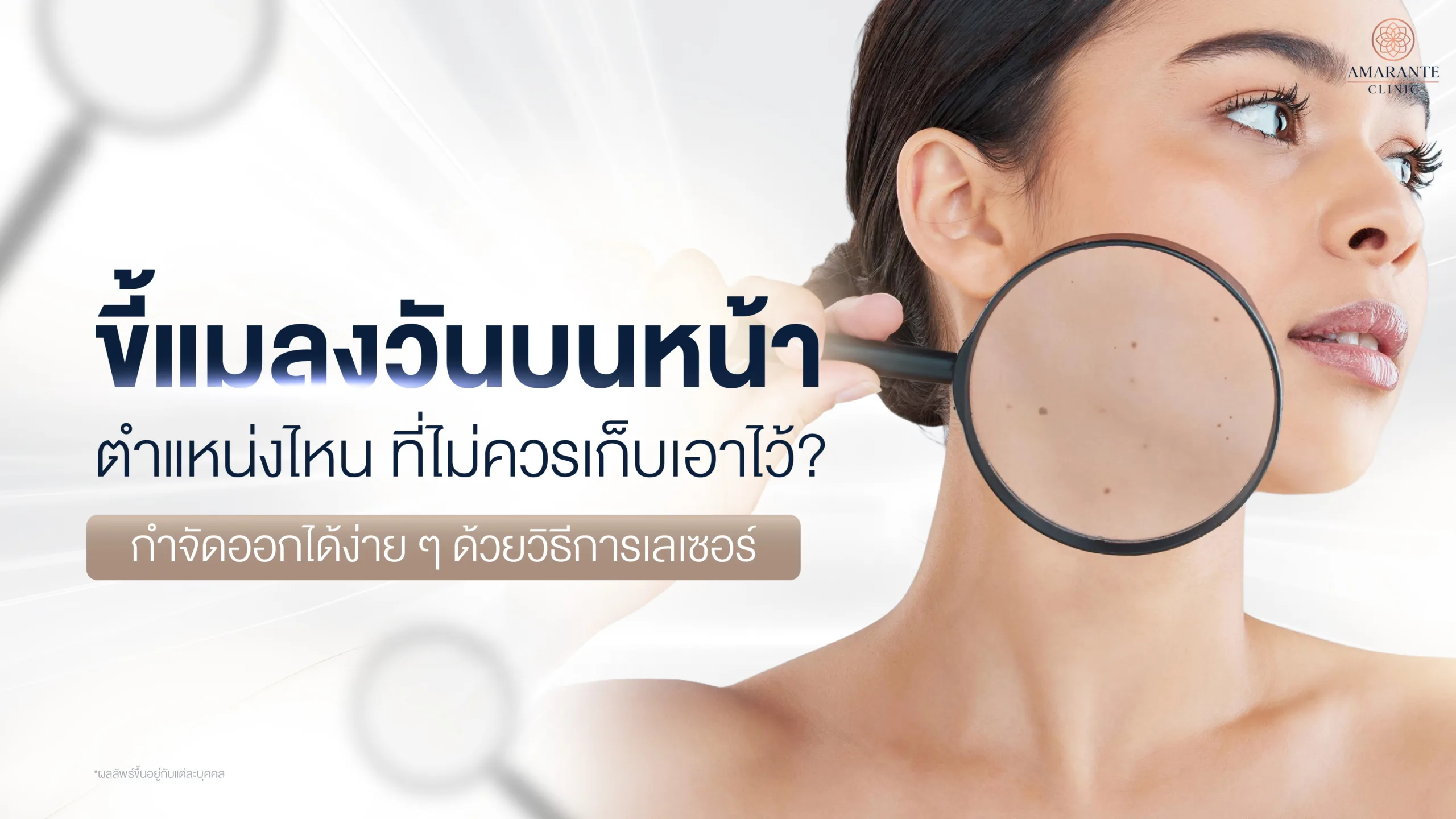 ขี้แมลงวันบนหน้าตำแหน่งไหนที่ไม่ควรเก็บเอาไว้ กำจัดออกได้ง่าย ๆ ด้วยการเลเซอร์