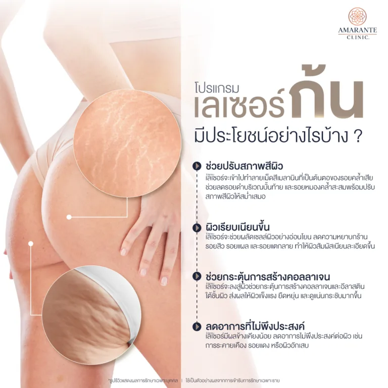 การเลเซอร์ก้นมีประโยชน์อย่างไรบ้าง