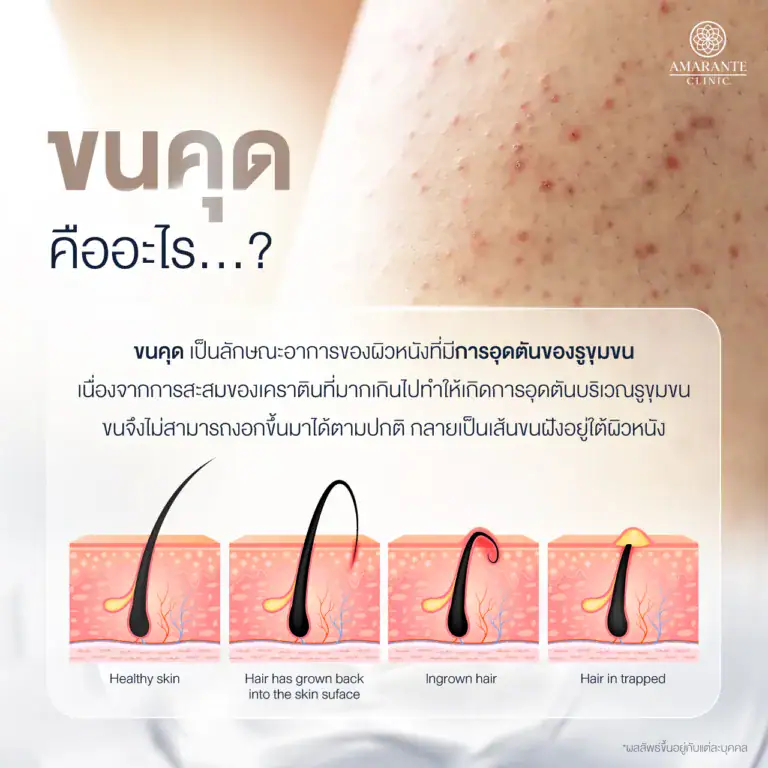 ขนคุดคืออะไร