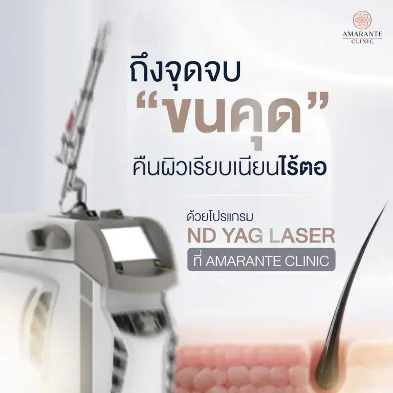 การเลเซอร์ขนคุด