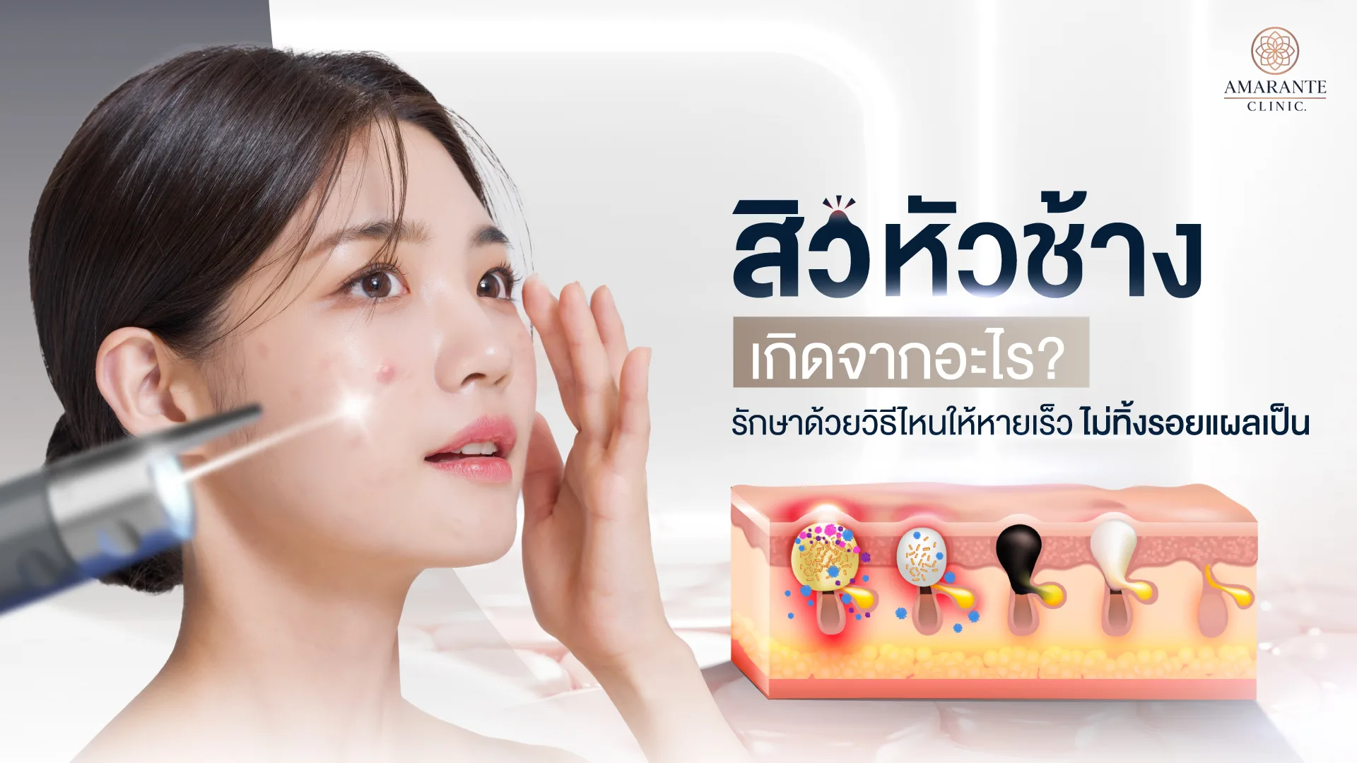 สิวหัวช้าง