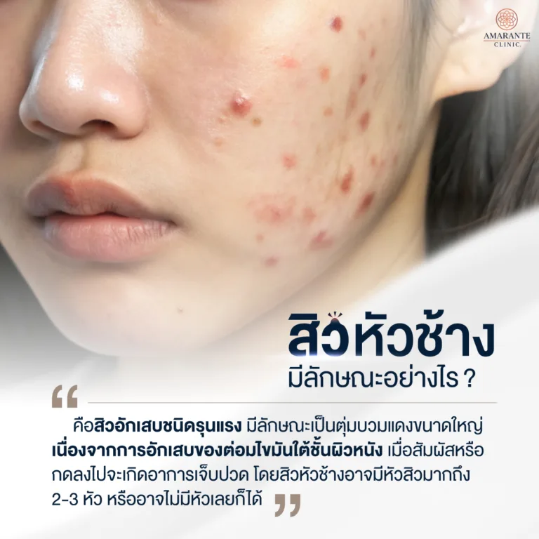 สิวหัวช้างเป็นยังไง