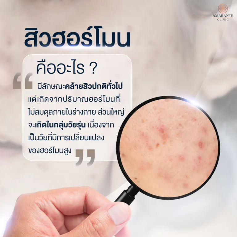 สิวฮอร์โมน คือ