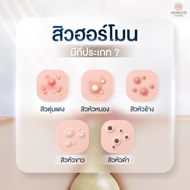 สิวฮอร์โมน มีกี่แบบ