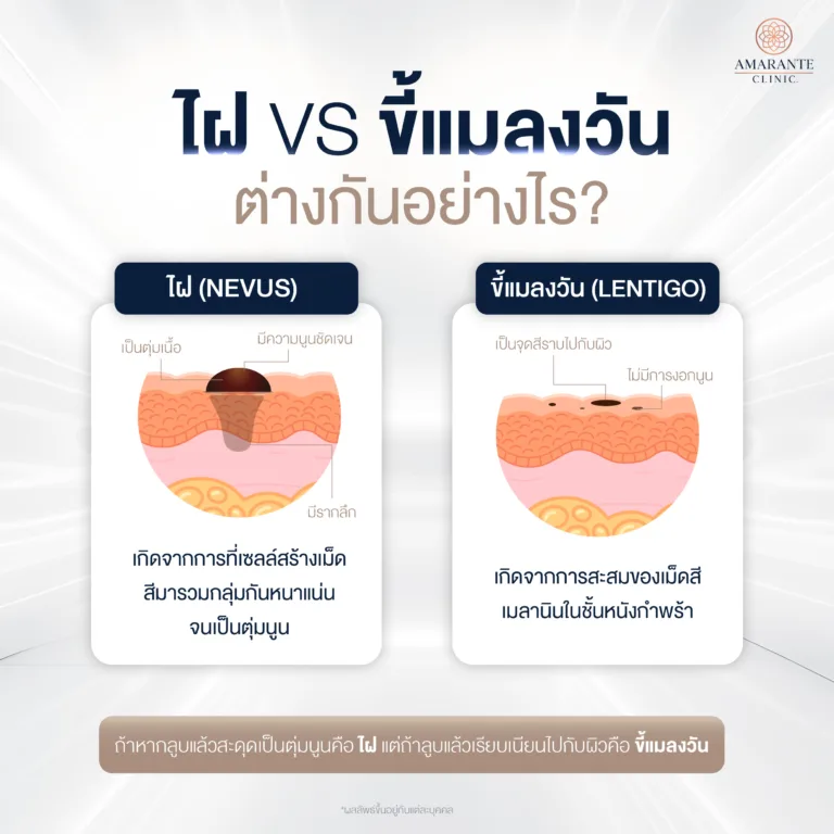 ไฝกับขี้แมลงวันต่างกันอย่างไร ?