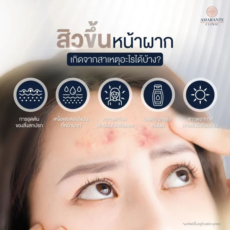 สิวขึ้นหน้าผาก สาเหตุเกิดจากอะไรบ้าง