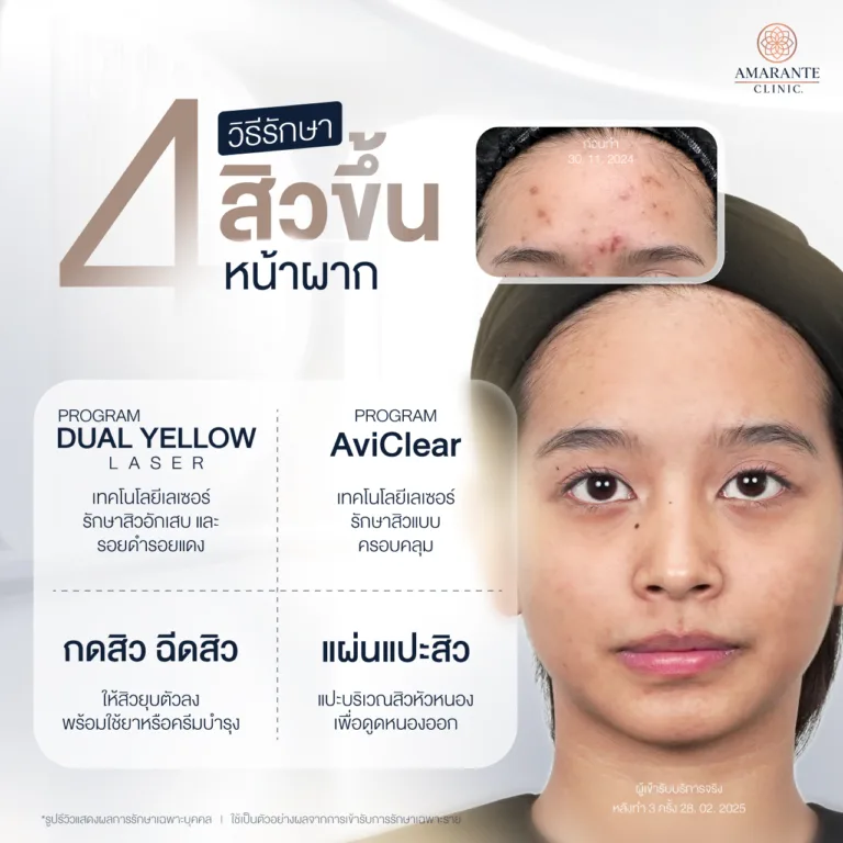 วิธีรักษาปัญหาสิวขึ้นหน้าผาก