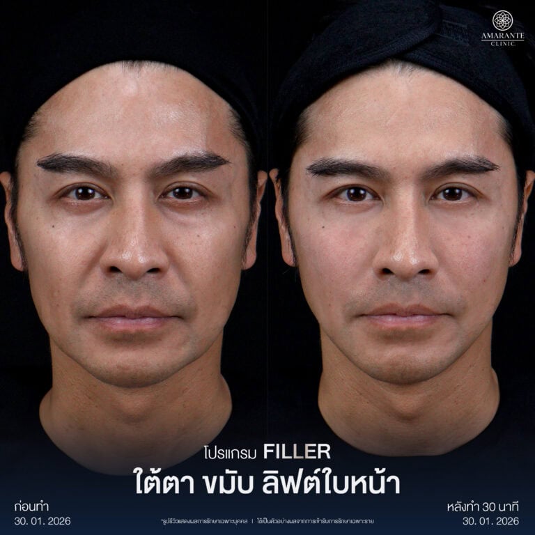 ฉีดฟิลเลอร์ใต้ตา ขมับ ลิฟท์กรอบหน้า