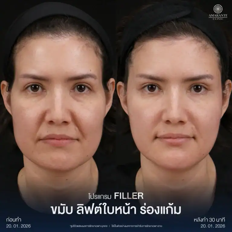 ฟิลเลอร์ ขมับ ลิฟท์ใบหน้า ร่องแก้ม