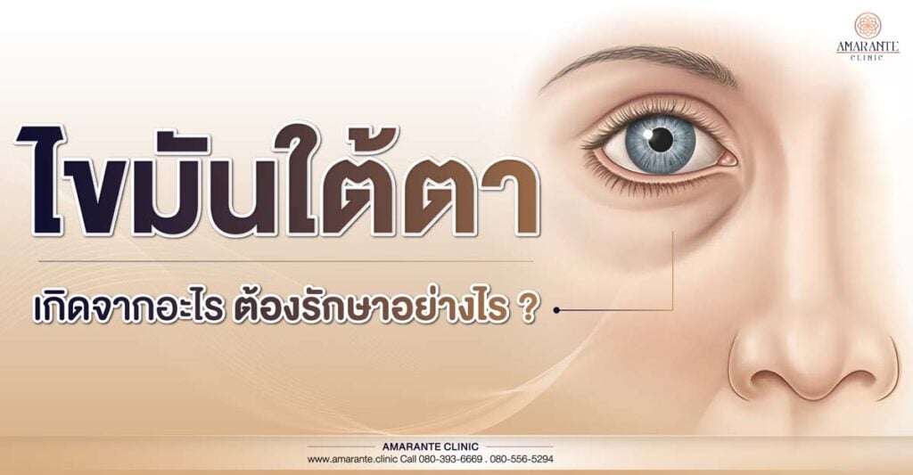 ไขมันใต้ตา