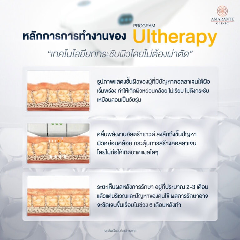 หลักการทำงานของ Ulthera