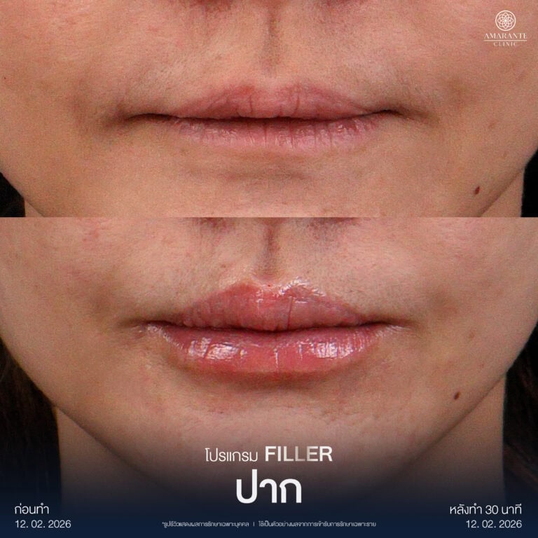 รีวิวฉีดฟิลเลอร์ปาก