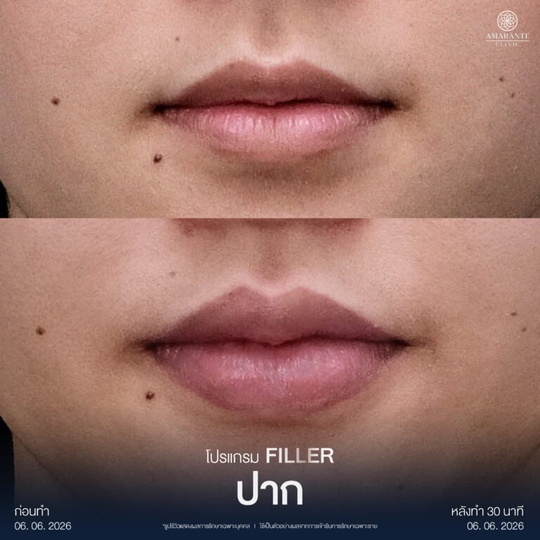 รีวิวฉีดฟิลเลอร์ปาก