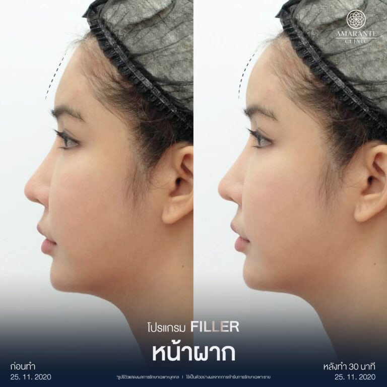 รีวิวฉีดฟิลเลอร์หน้าผาก