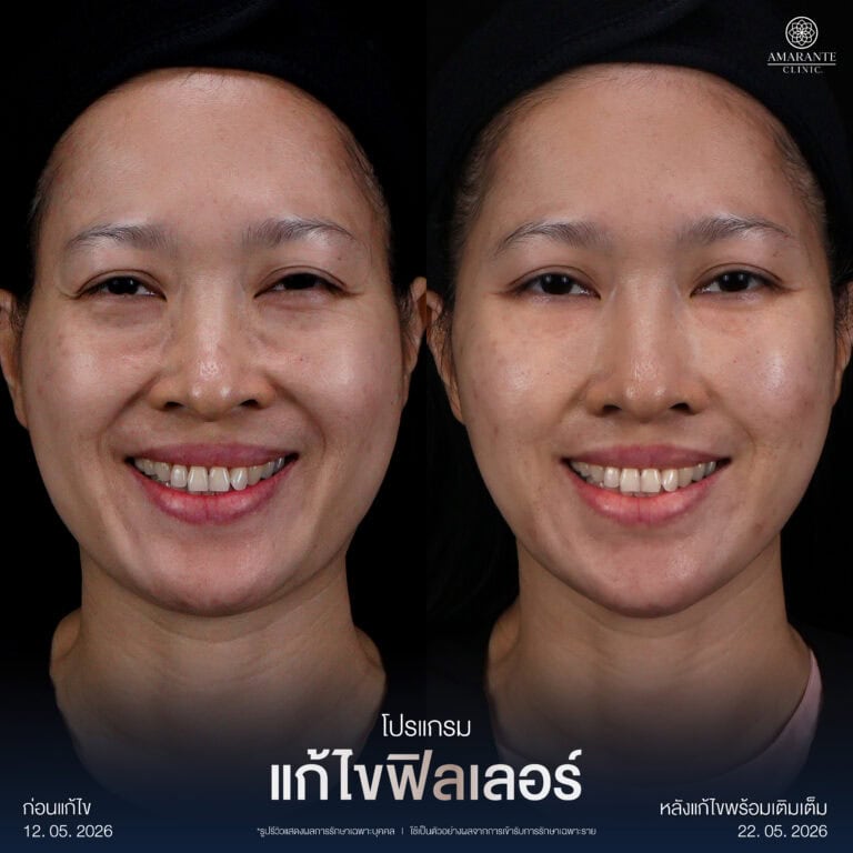 รีวิวฉีดฟิลเลอร์หน้าผาก
