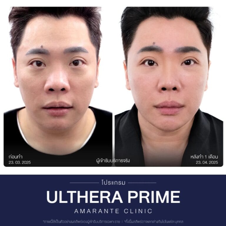รีวิว Ulthera