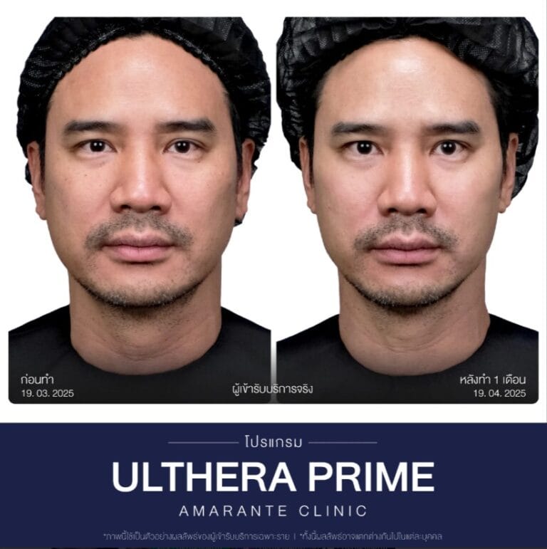 รีวิว Ulthera