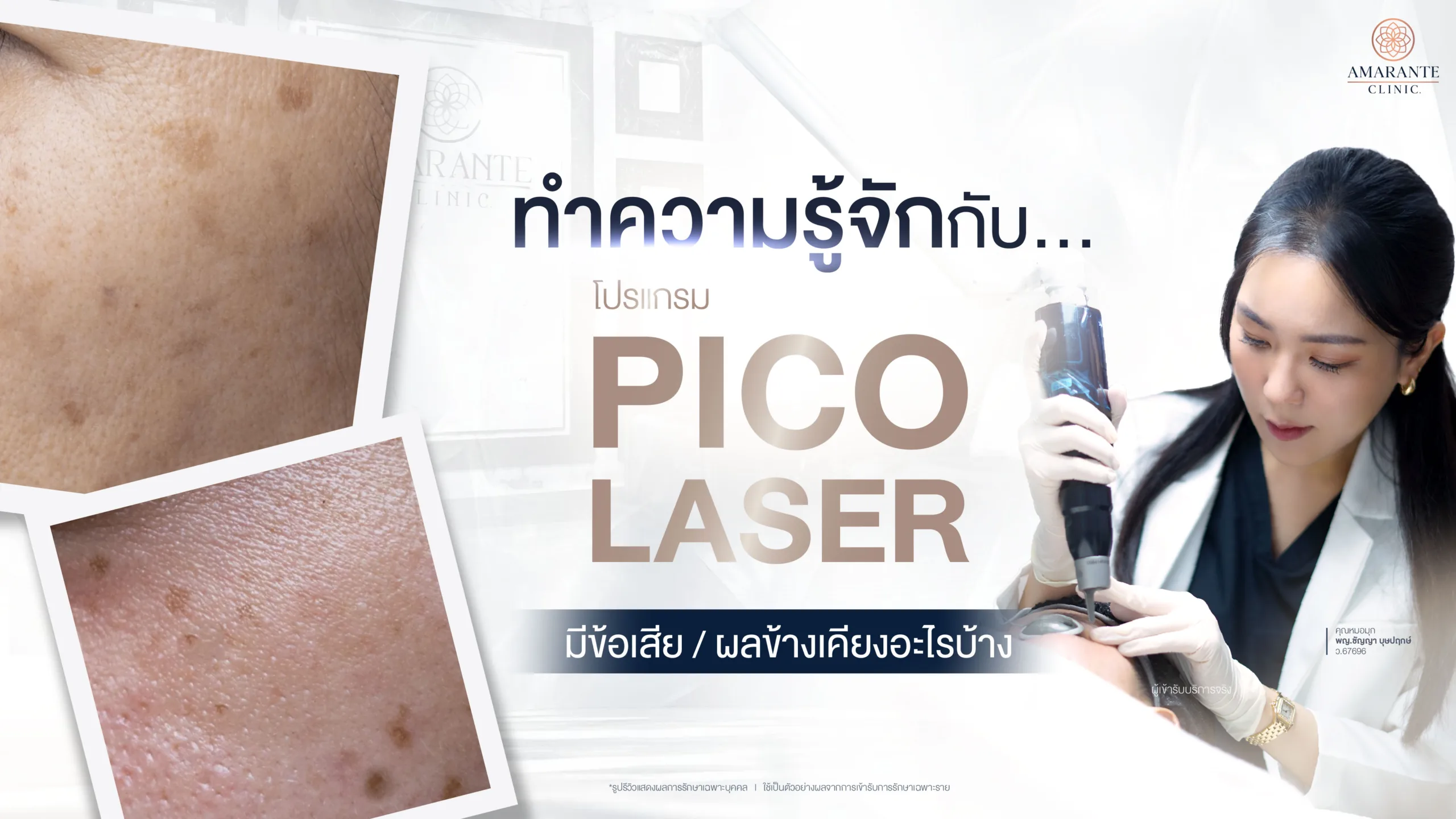 pico laser ข้อเสีย และข้อดีคืออะไร