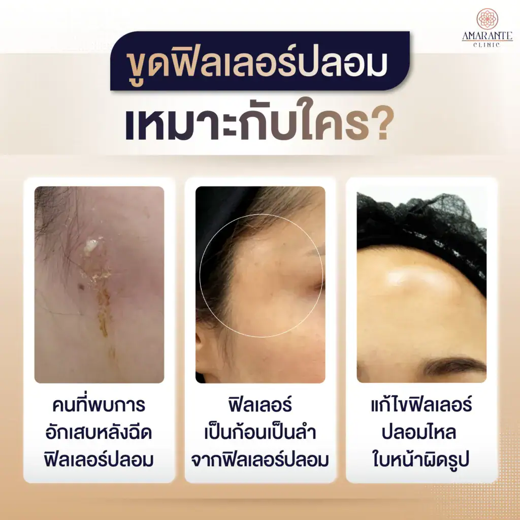 ขูดฟิลเลอร์ปลอมอันตรายไหม? ฟังคำตอบจากศัลยแพทย์ตกแต่งเฉพาะทาง 7