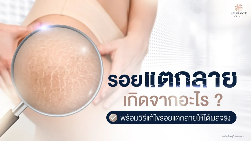 รอยแตกลายสีขาว สีแดงเกิดจากอะไร