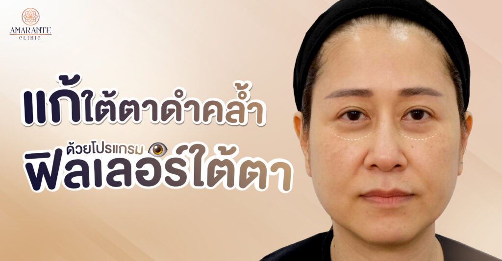 แก้ใต้ตาดำคล้ำ ด้วยโปรแกรมฟิลเลอร์ใต้ตา