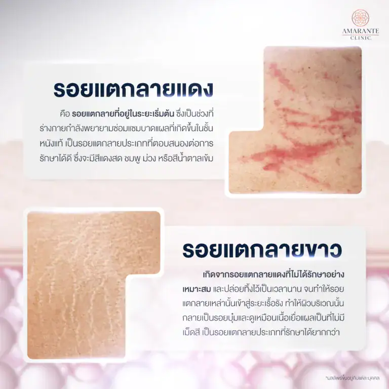 ประเภทของรอยแตกลาย