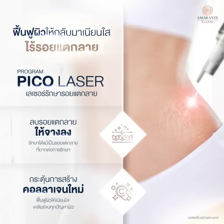 Pico Laser รักษารอยแตกลาย ที่ Amarante Clinic