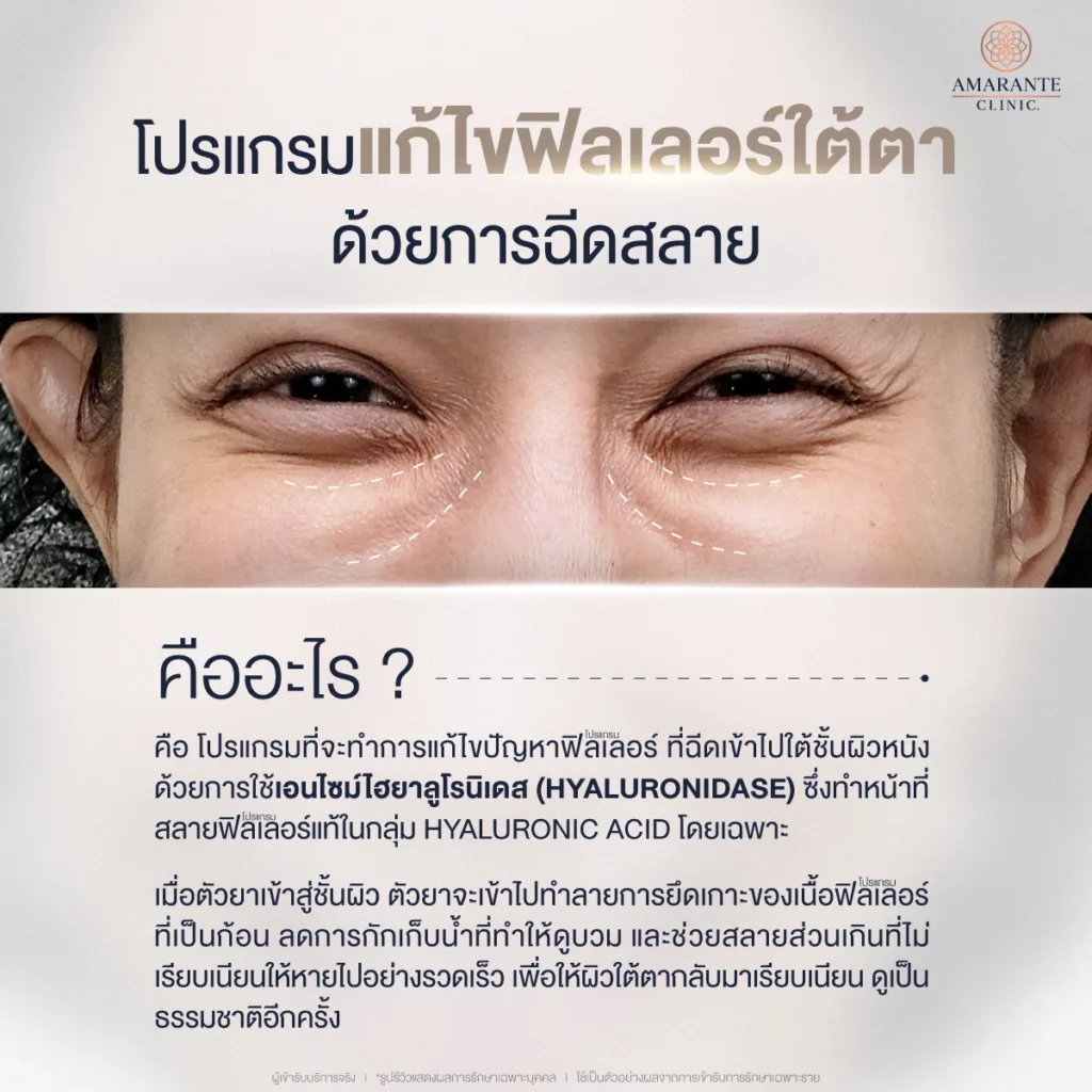โปรแกรมฉีดสลายฟิลเลอร์ใต้ตา คืออะไร
