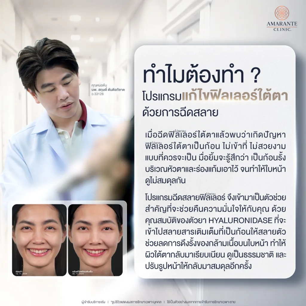 ทำไมต้องทำโปรแกรมฉีดสลายฟิลเลอร์ใต้ตา