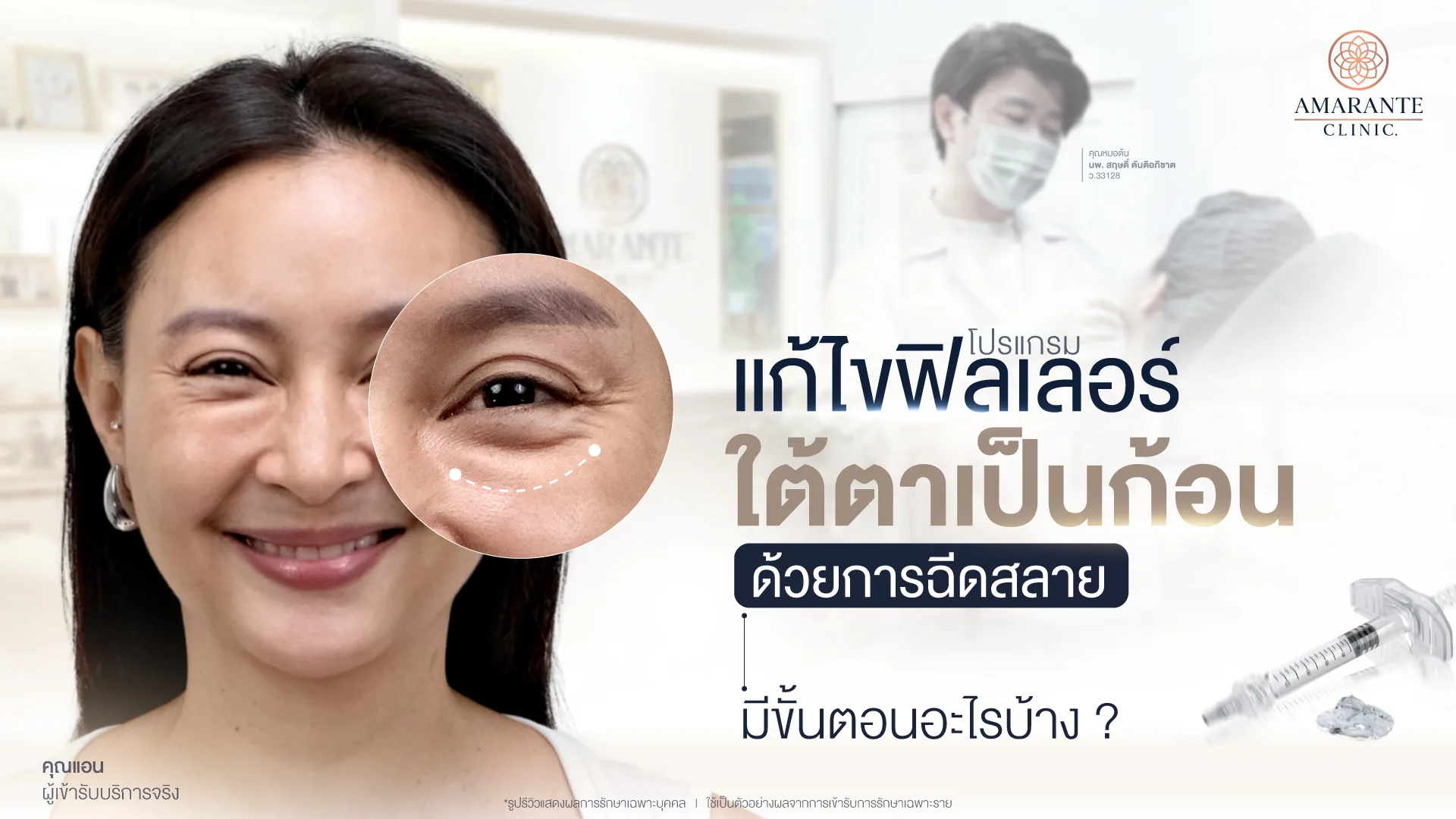 ฉีดสลายฟิลเลอร์ใต้ตาเป็นก้อน