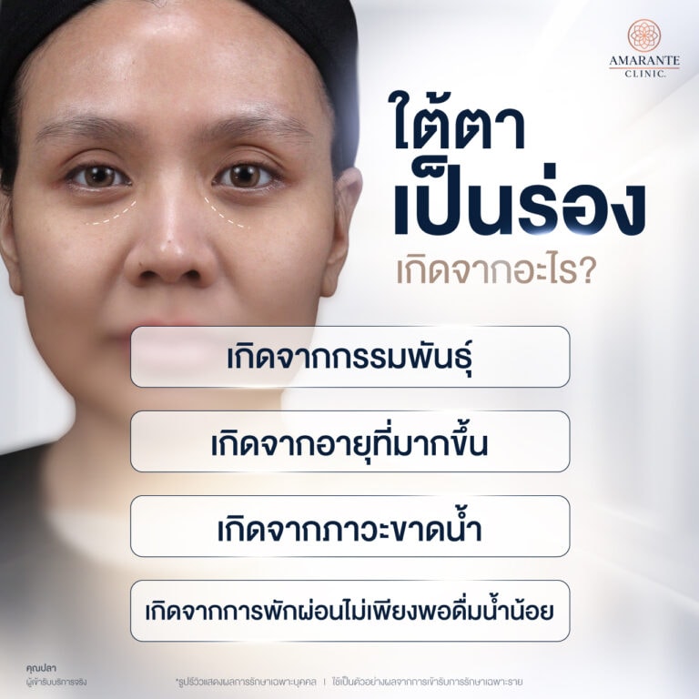 ใต้ตาเป็นร่อง เกิดจากอะไร