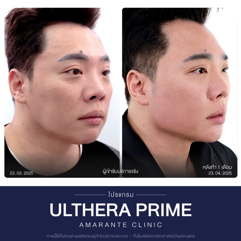 รีวิวทำโปรแกรม Ulthera ที่ Amarante Clinic