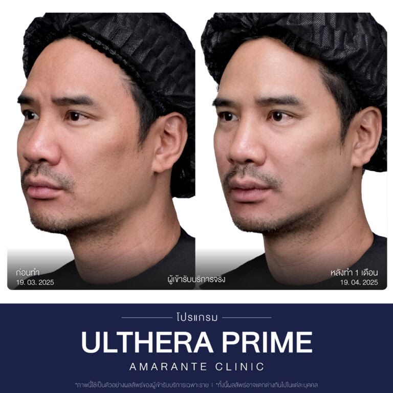 รีวิวทำโปรแกรม Ulthera ที่ Amarante Clinic