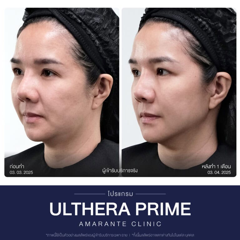 รีวิวทำโปรแกรม Ulthera ที่ Amarante Clinic