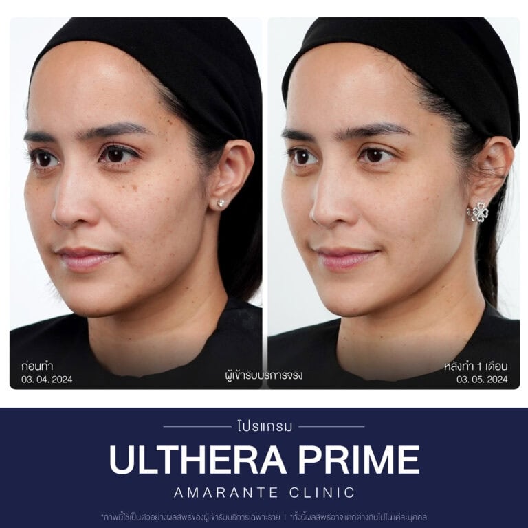 รีวิวทำโปรแกรม Ulthera ที่ Amarante Clinic