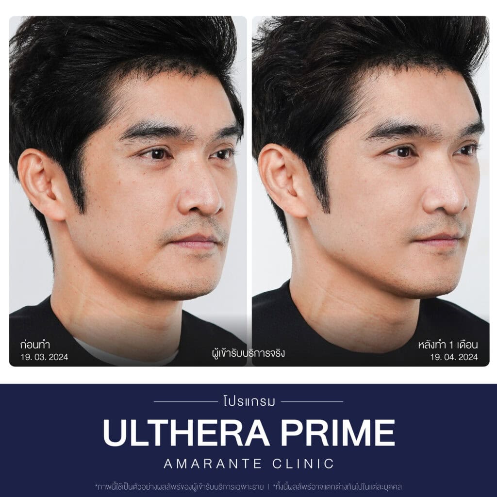 รีวิวทำโปรแกรม Ulthera ที่ Amarante Clinic
