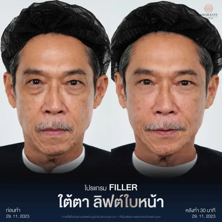 รีวิวฉีดฟิลเลอร์ใต้ตาที่ Amarante Clinic