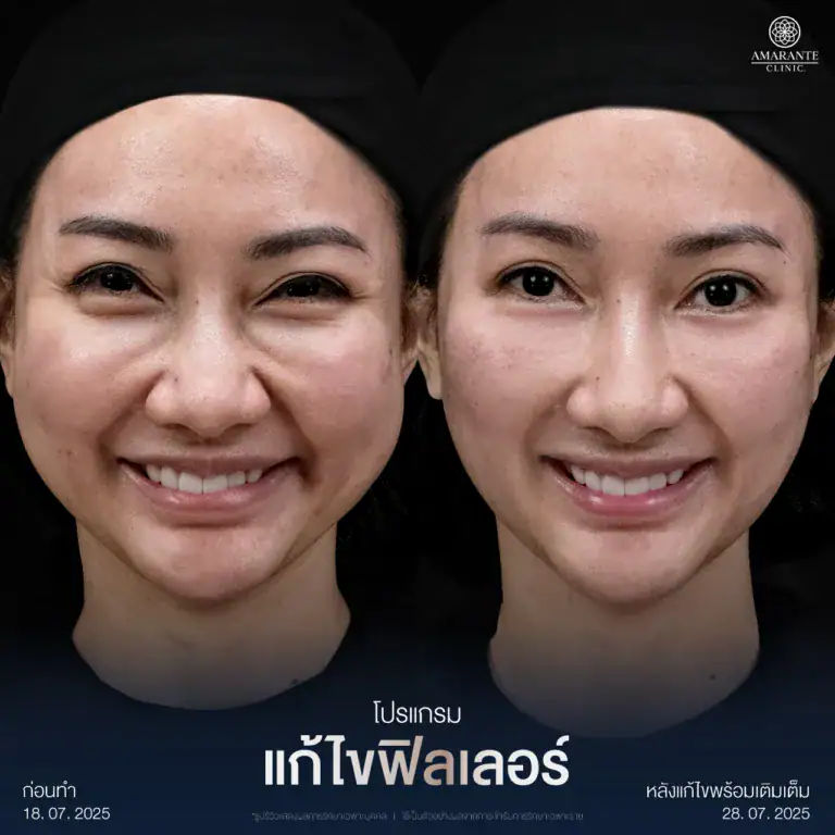 รีวิวแก้ไขฟิลเลอร์เป็นก้อนใต้ตา ที่ Amarante Clinic